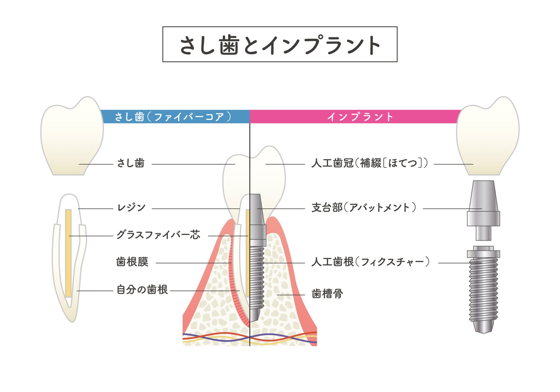 差し歯とインプラントの違いは何?どちらを選んだら良い? – 千葉県流山市・新松戸のインプラント治療なら北村総合歯科
